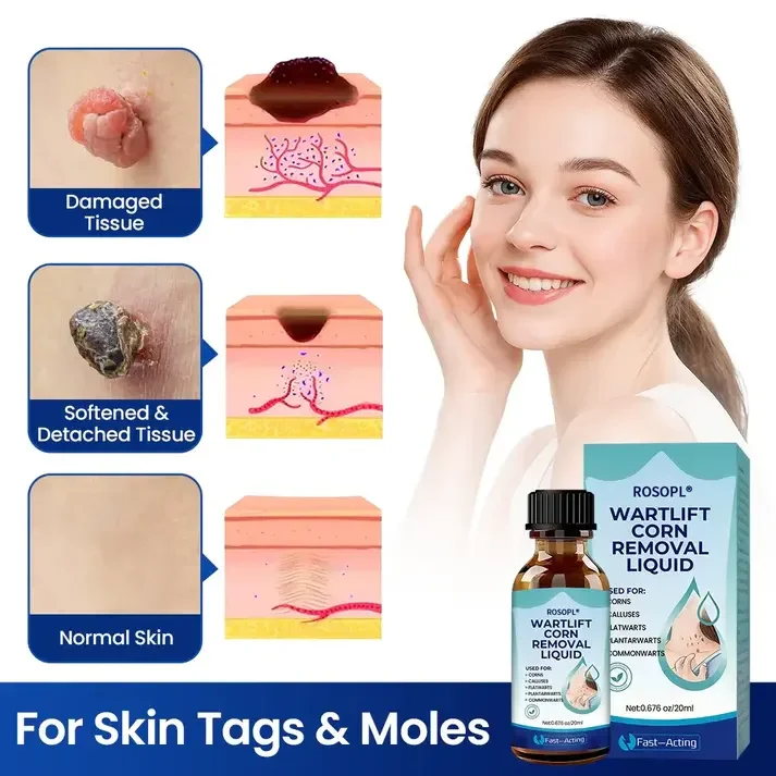 ROSOPL® Wart Lift Wart Removal Liquid - Image 4